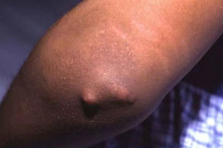 风湿性结节胳膊肘有小硬疙瘩图