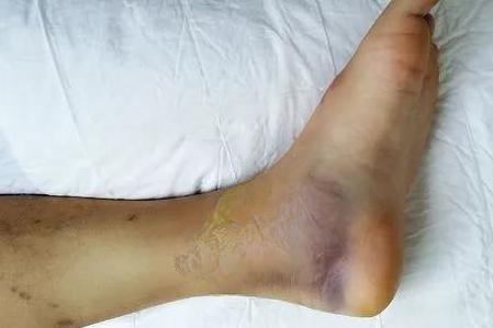跟骨粉碎性骨折外观图