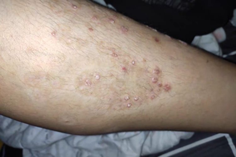 慢性湿疹小水疱图