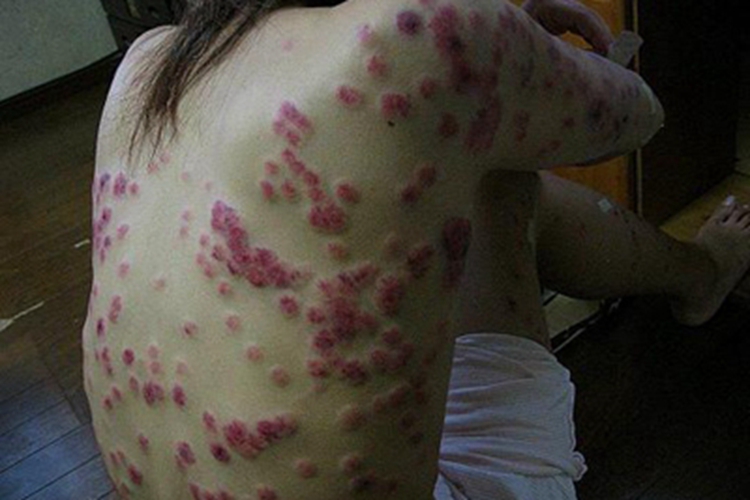 结节性梅毒疹背部症状图