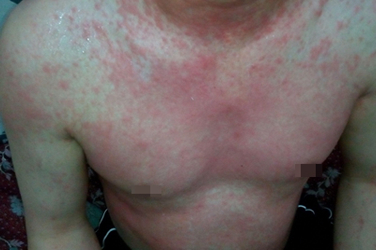 青年成人期特应性皮炎胸部红斑图