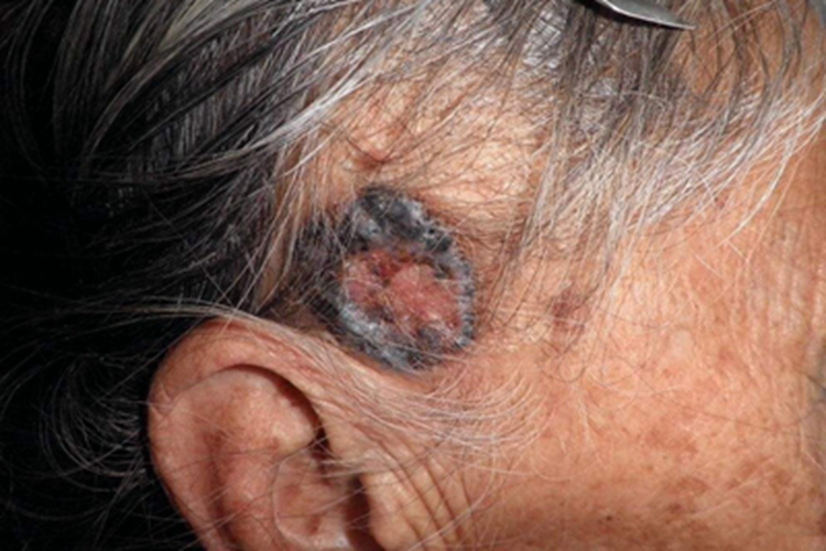 恶性黑色素瘤面部斑块图 恶性黑色素瘤面部斑块图