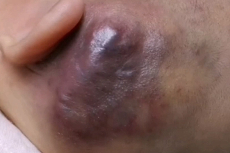 卡波西样血管内皮瘤硬块图