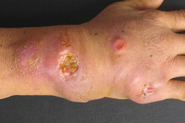 龟分枝杆菌皮肤感染手腕症状图