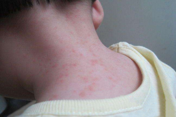 幼儿麻疹型药疹图