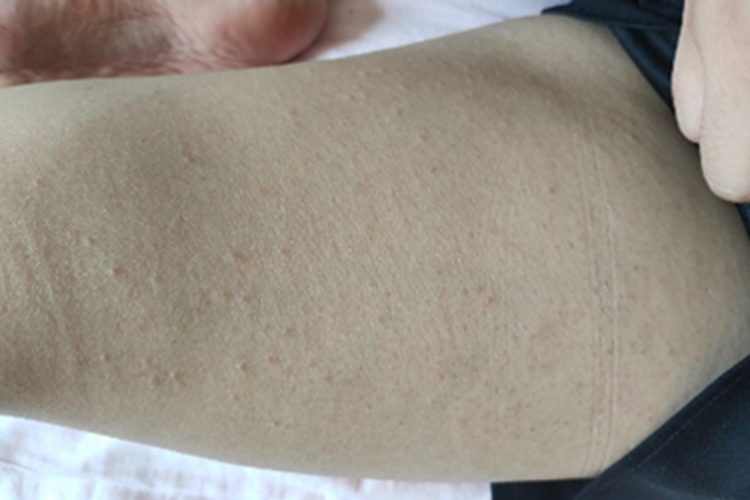 毛囊角化病胳膊小疙瘩图