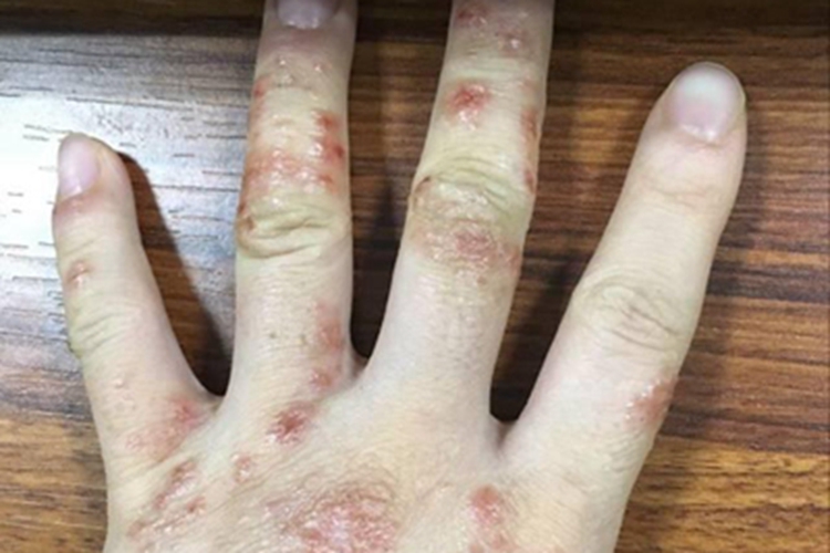 亚急性湿疹手部脱屑图 亚急性湿疹手部脱屑图