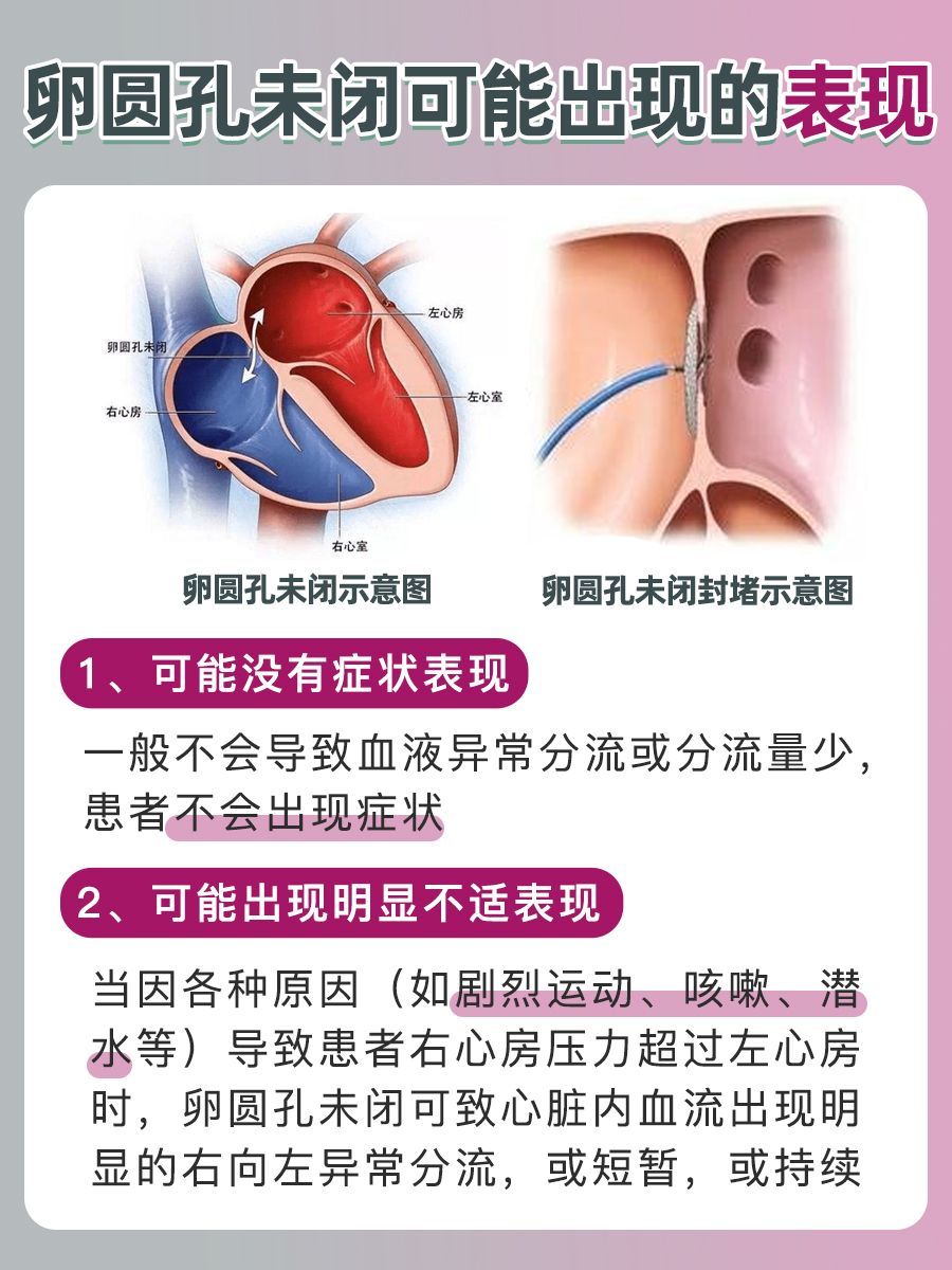 卵圆孔未闭术后如何睡眠：关注术后睡姿