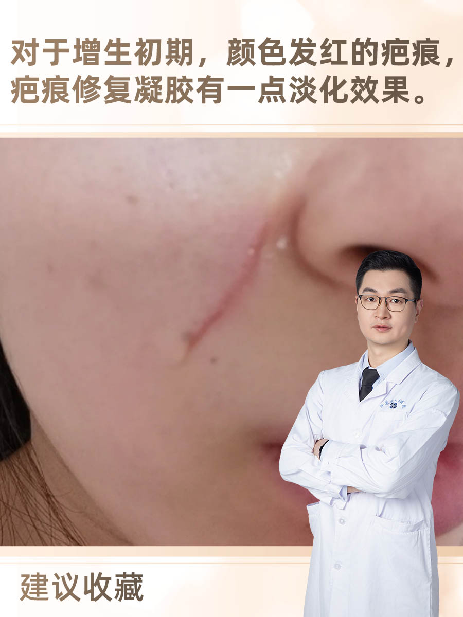 分享！疤痕修复凝胶效果怎么样？