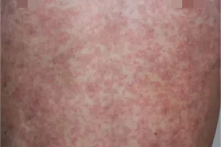 登革热腹部红斑图 登革热腹部红斑图