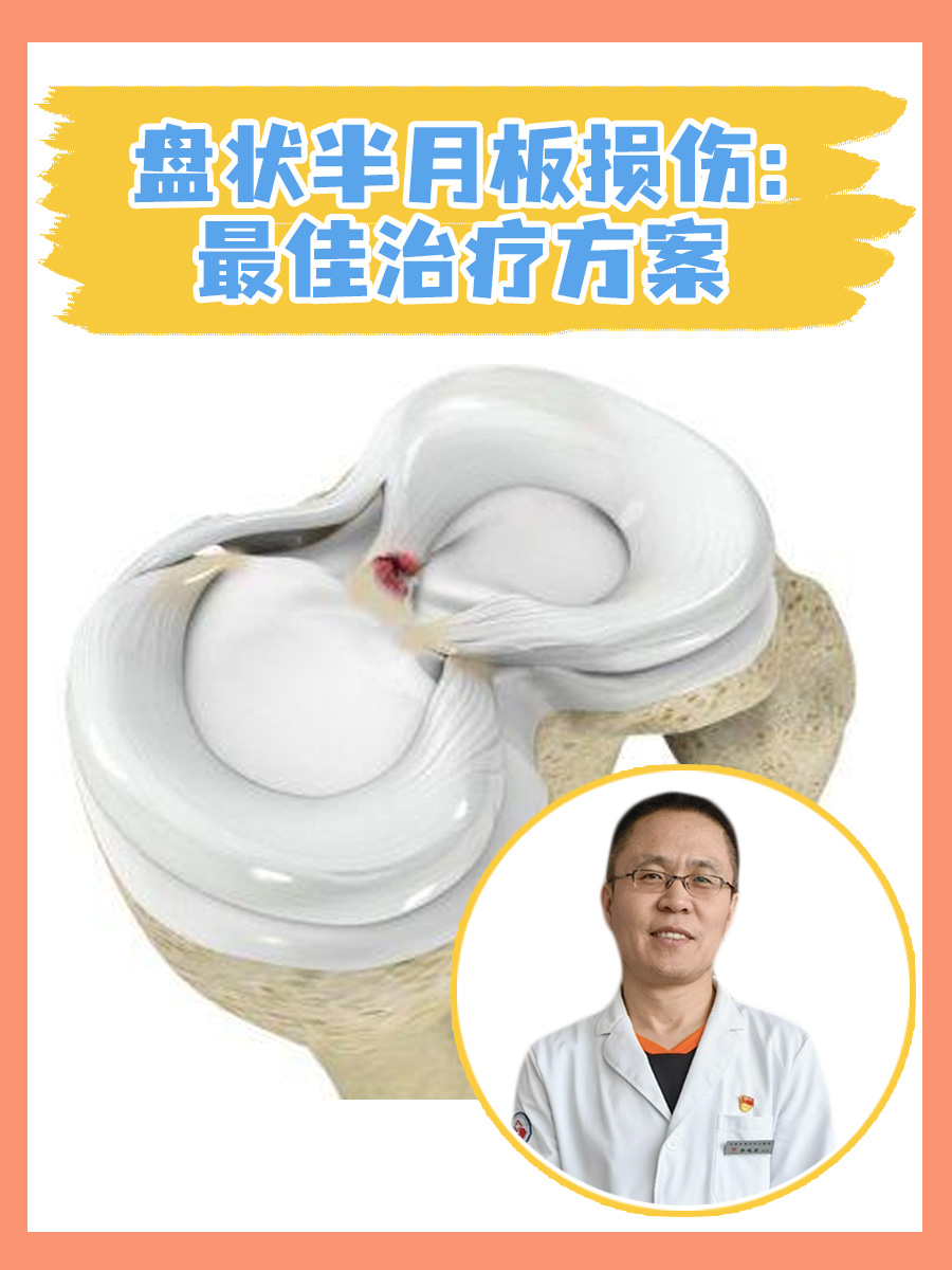 盘状半月板损伤：最佳治疗方案
