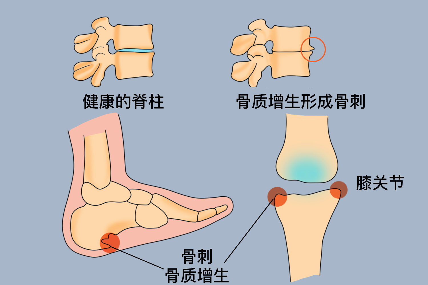 骨质增生图 骨质增生图