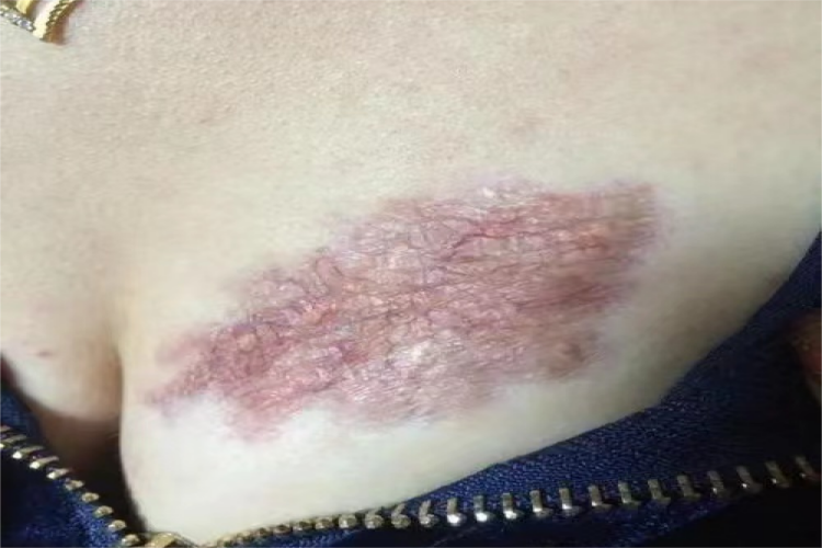 瘢痕疙瘩乳房疙瘩图