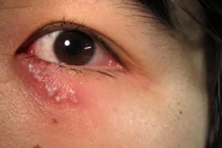 单纯疱疹眼睑红肿图 单纯疱疹眼睑红肿图
