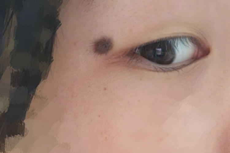 眼睑交界痣眼睑小疙瘩图 眼睑交界痣眼睑小疙瘩图