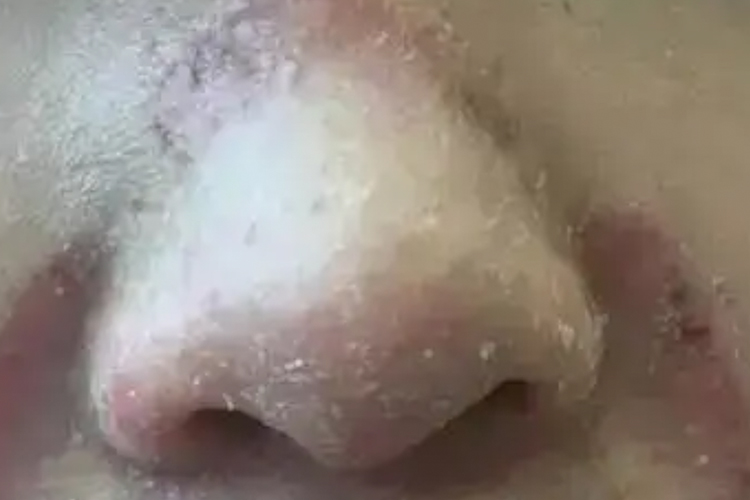 脸上感染脚气图