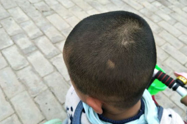 轻微的儿童斑秃图