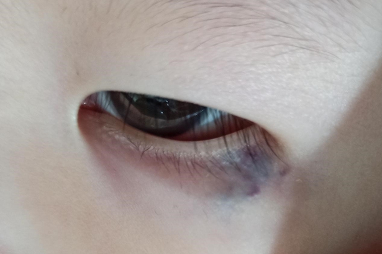 孩子眼睛周围外伤瘀青血肿图