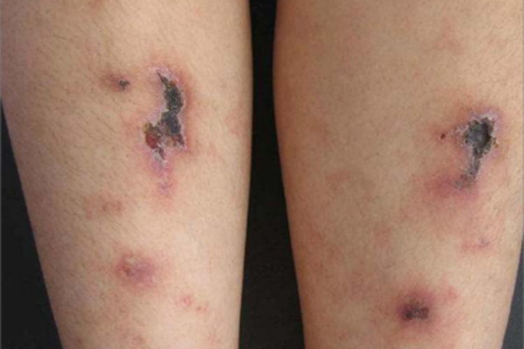 变应性皮肤结节性血管炎症状图 变应性皮肤结节性血管炎症状图