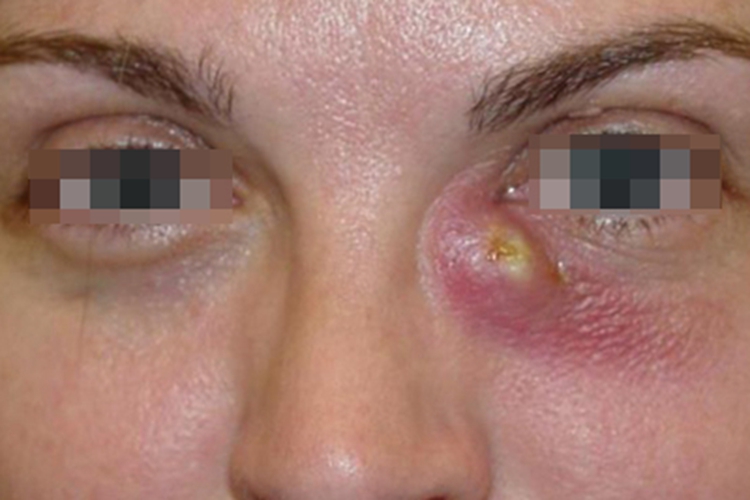 慢性泪囊炎眼部症状图