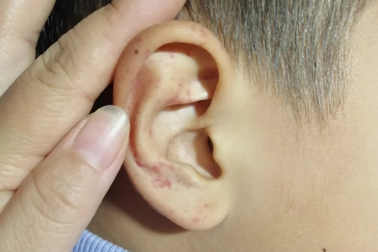 过敏性紫癜耳朵红点图