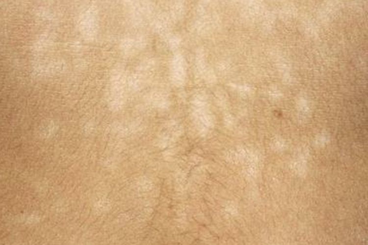 肚皮白色糠疹图