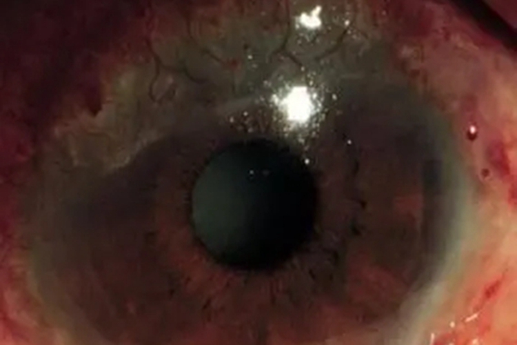 韦氏肉芽肿病眼球溃疡图