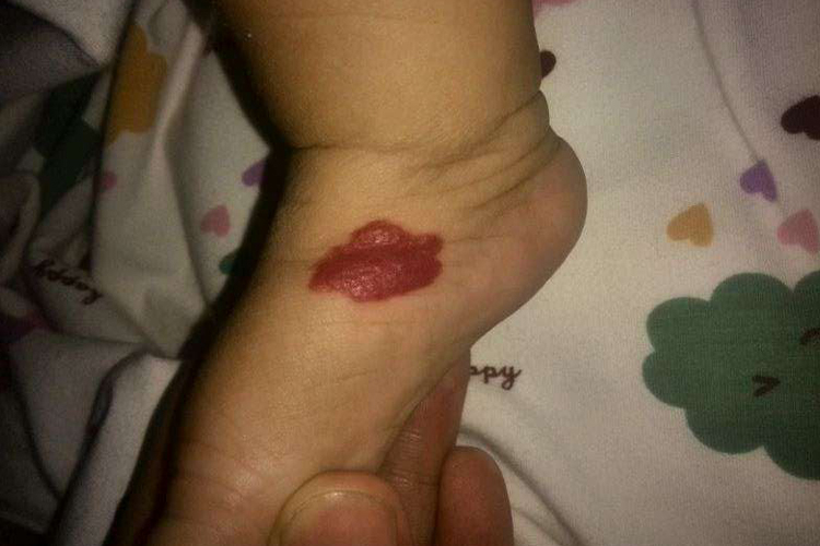 脚背的早期海绵状血管瘤图