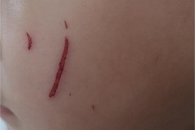 抓伤面部症状图