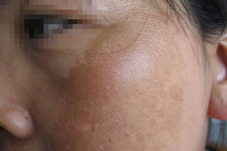 面部肝斑图 面部肝斑图