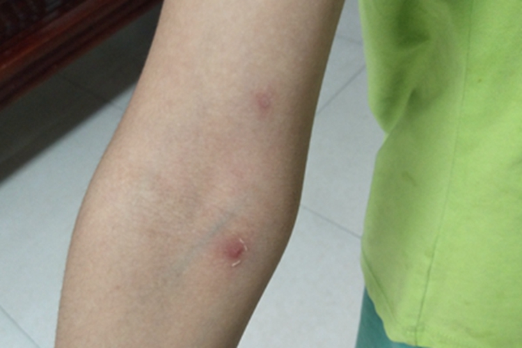 水痘右胳膊上有瘢痕脱屑图