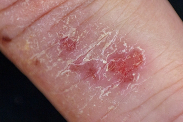 皲裂性湿疹手指有红斑脱皮图