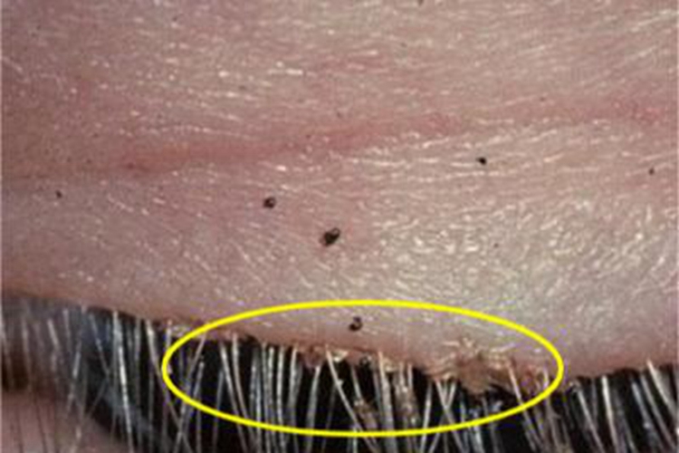 阴虱病眼睑虫卵图