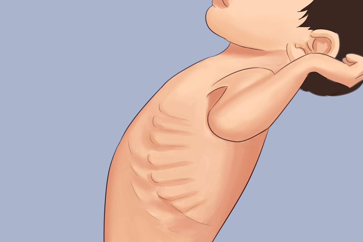 婴儿维生素D缺乏性佝偻病图