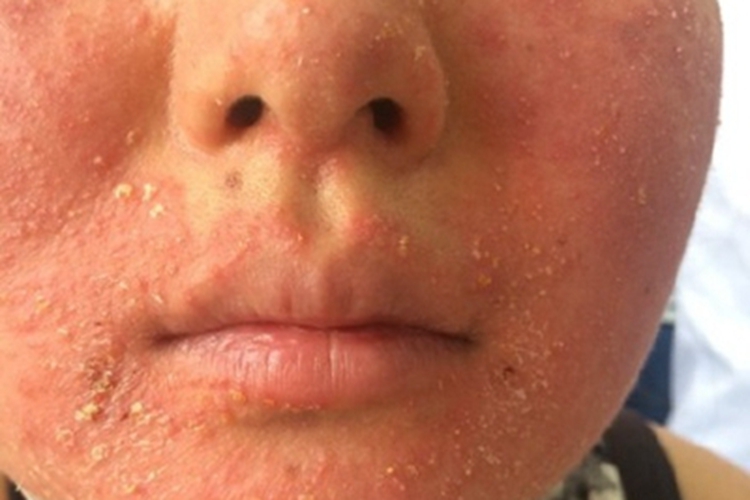 丘疹脓疱型酒糟鼻面部红斑图