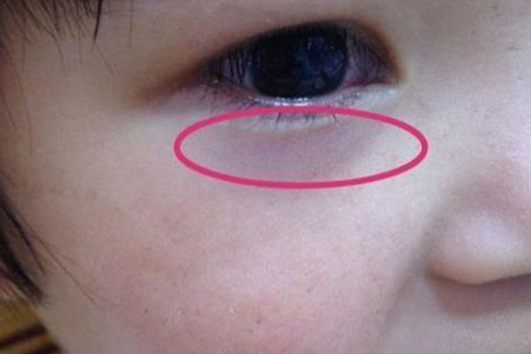 脾胃虚孩子眼睛下青紫图