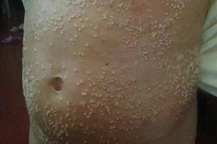 痱子出现白点图