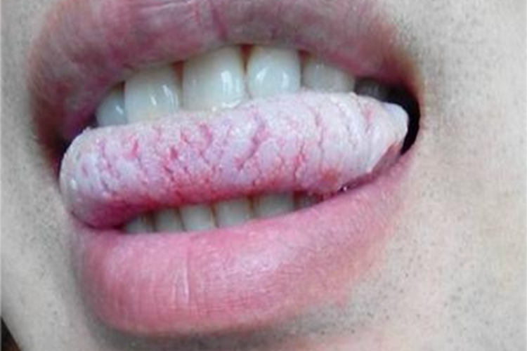 口腔白斑病舌尖白斑图 口腔白斑病舌尖白斑图