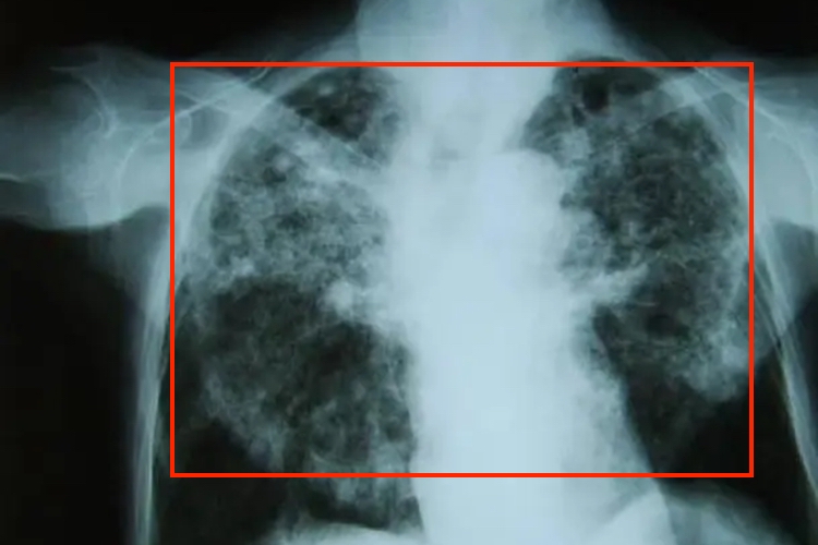 电焊尘肺病的早期症状图 电焊尘肺病的早期症状图