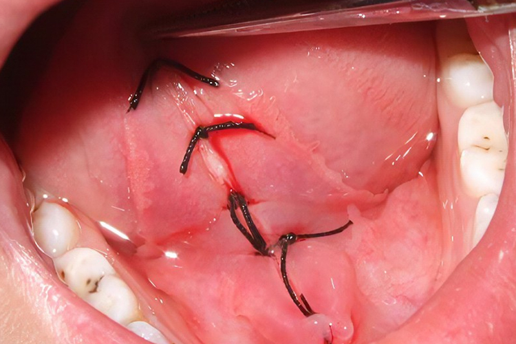 舌系带剪完以后图