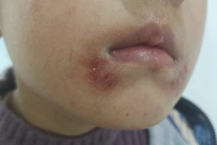 慢性期口周湿疹红斑图