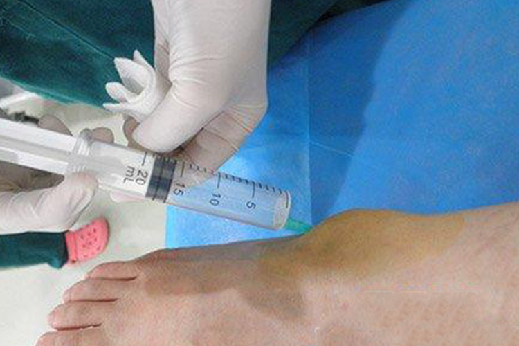 踝关节前外侧注射图