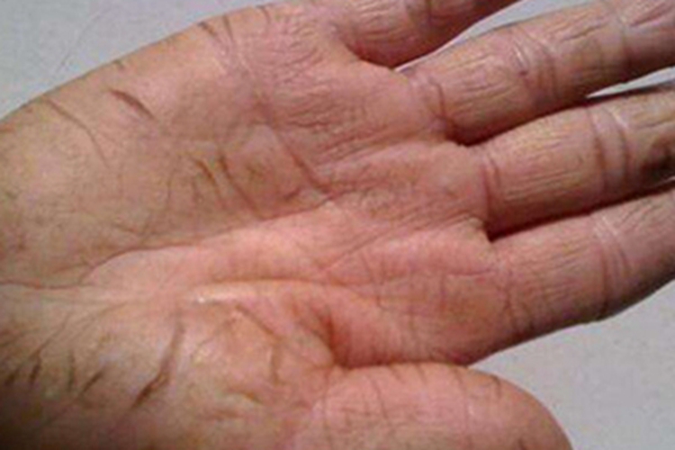 Ⅲ度皮肤皲裂手掌裂纹图