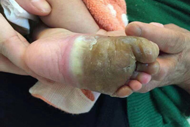 连续性肢端皮炎脚底结痂图