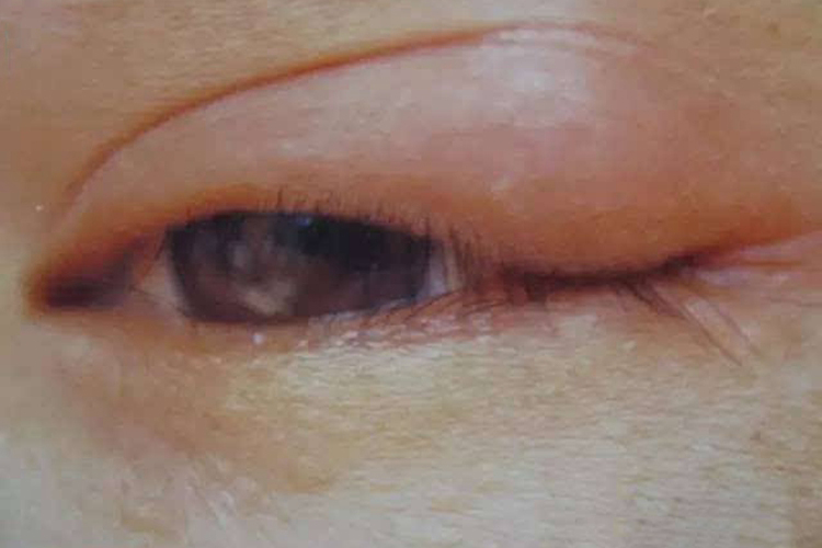 眼角处睑板腺囊肿图