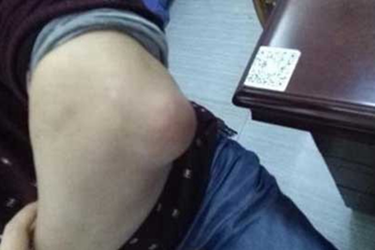 痛风肘部长大包块图