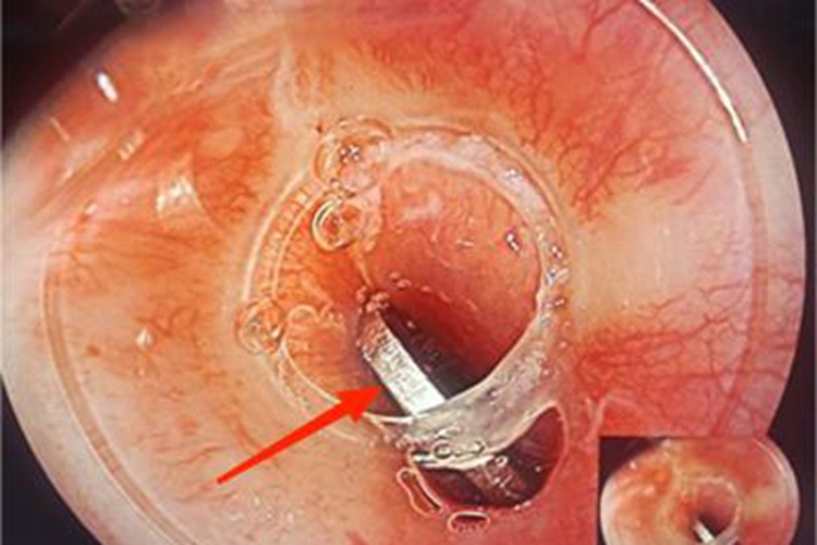 食管异物硬物卡在食道图