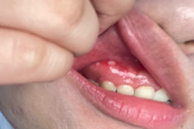 口腔溃疡牙龈出现溃疡图