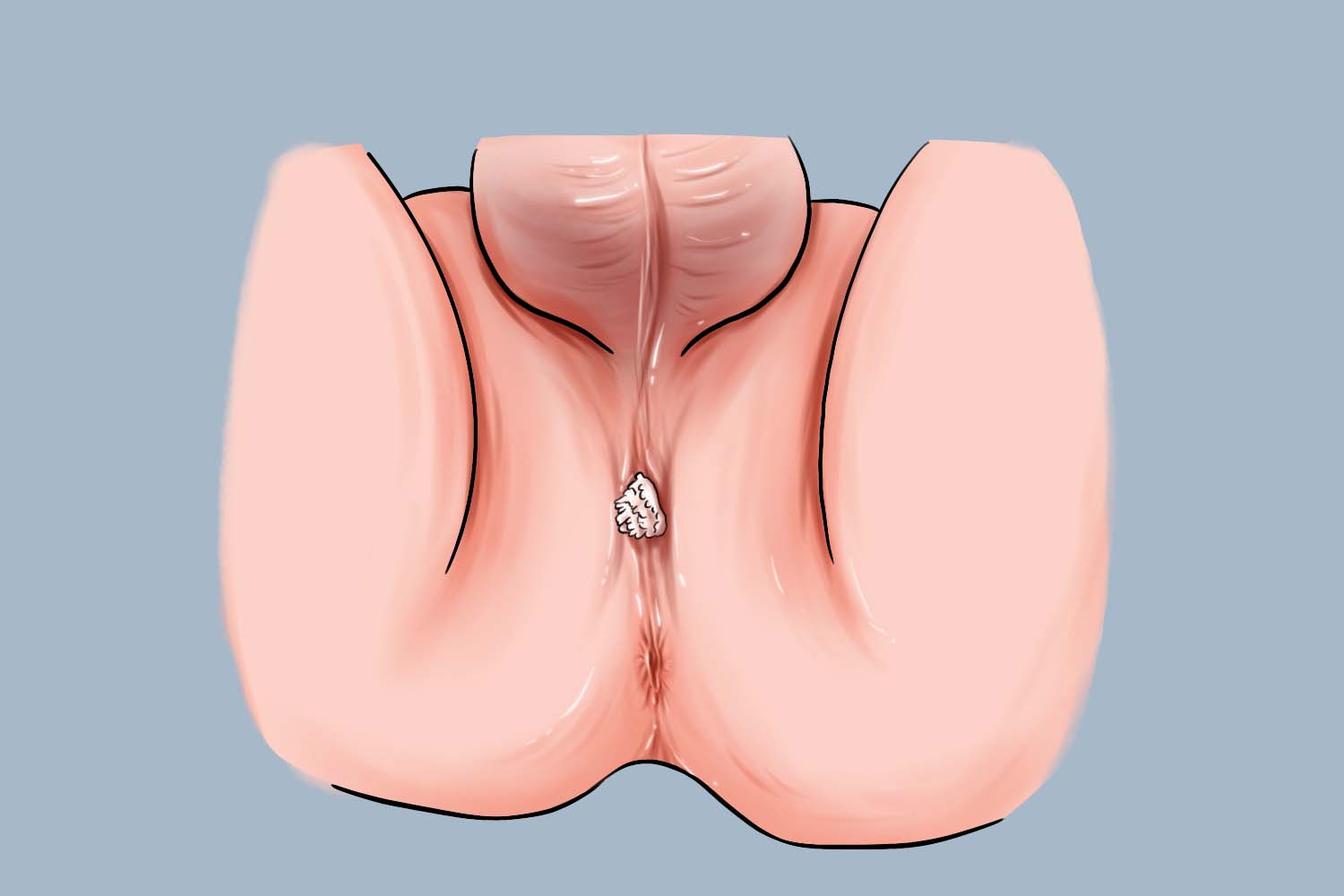 尖锐湿疣肛门下方疙瘩图 尖锐湿疣肛门下方疙瘩图