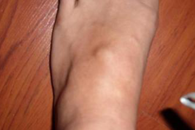 小孩脚背腱鞘囊肿图